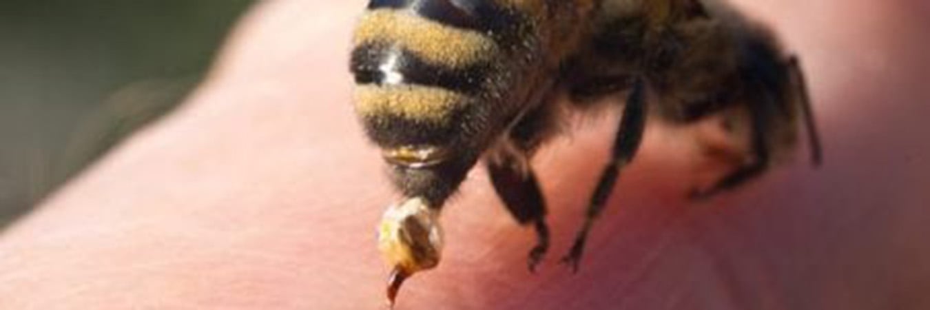 bee sting